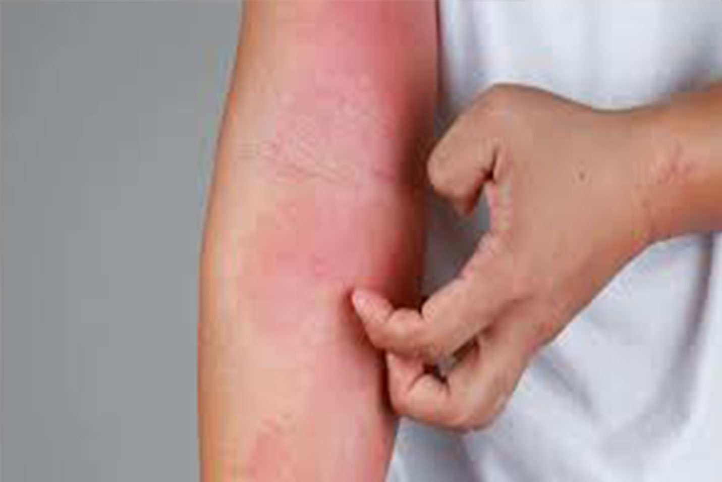 Blood Allergy Test