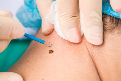 Wart Removal with Electrocautery