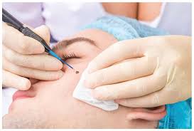 Corns Before Treatment