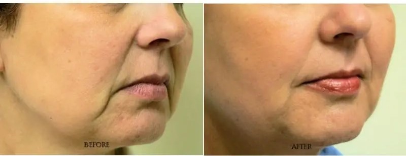 Dermal Fillers for Facial Volume