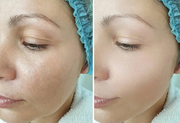 Skin Recovery