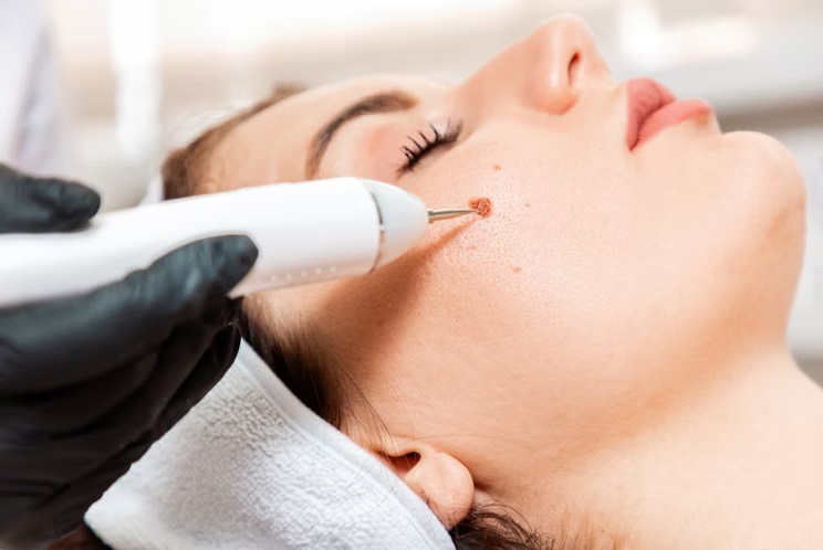 Radiofrequency for Moles & Skin Tags