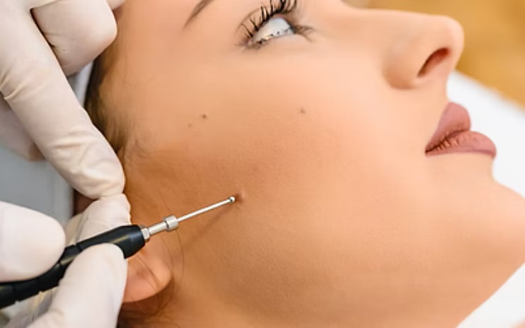 Skin tag removal
