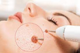 Mole excision