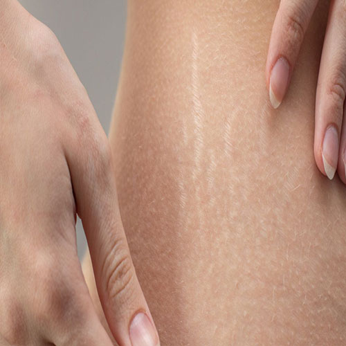 Microneedling results for stretch marks