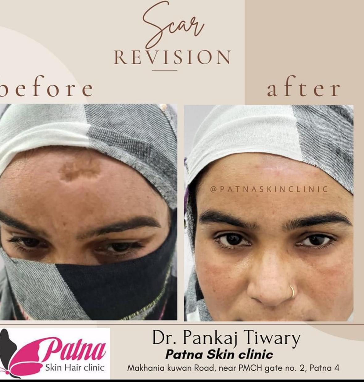 Skin Graft Healing