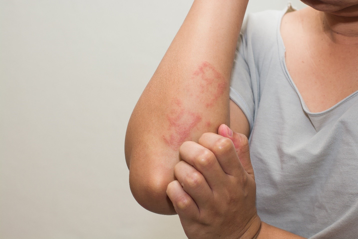 Skin Prick Test