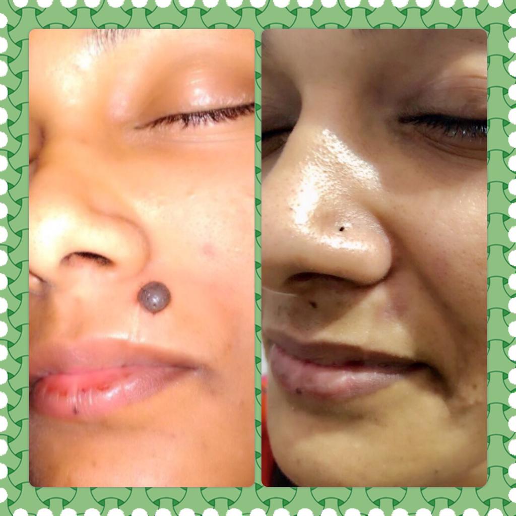 CO2 Laser Treatment