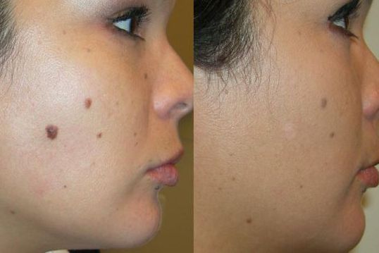 Healing after RF
