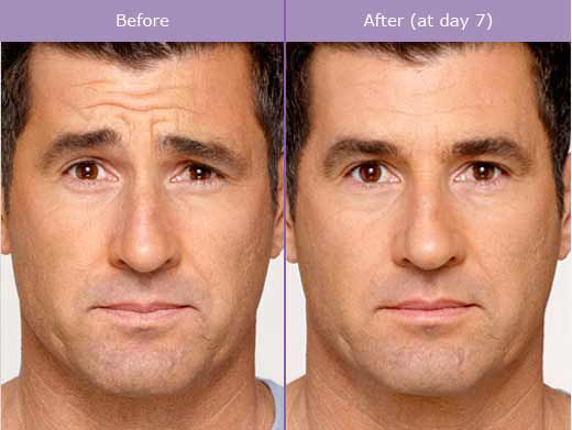 Botox Injection Process